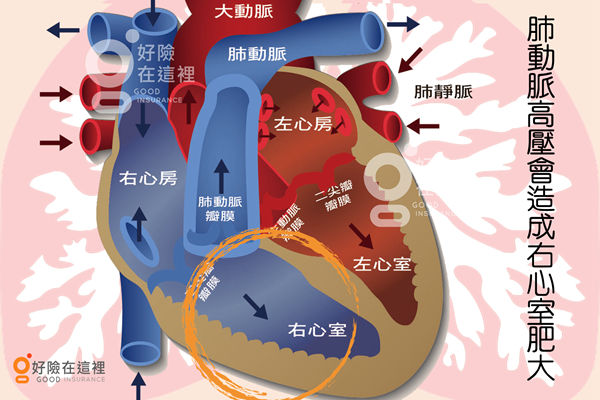 勞 心 又勞 肺 特定傷病肺動脈高血壓怎麼賠 Goodins 好險在這裡